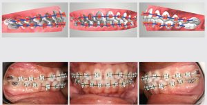 Simulated-Brackets-Matched-with-Real-Patient-Brackets - Bhatia Orthodontics