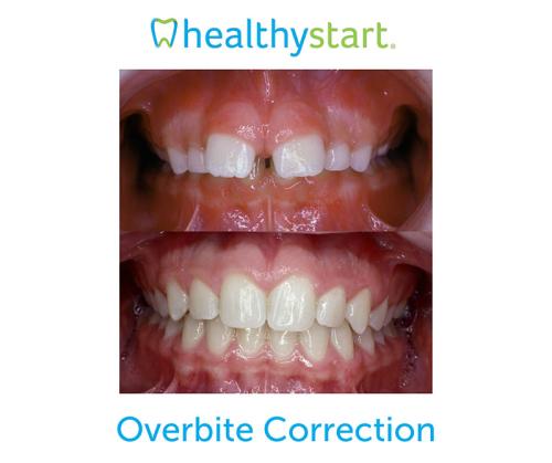 Overbite-Correction-RFS