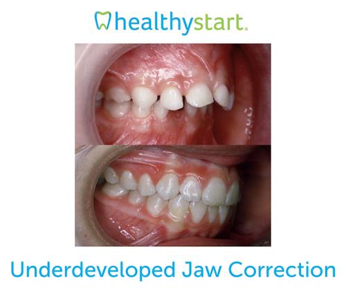 Underdeveloped-Jaw-Correction-RFS
